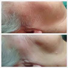 Release Peeling, hårfjerning